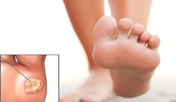 Bệnh nấm ở bàn chân và cách điều trị tốt nhất